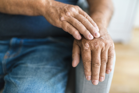 male hands with psoriatic arthritis